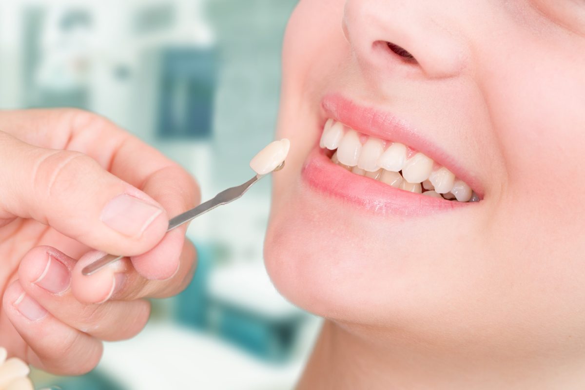 removable teeth braces